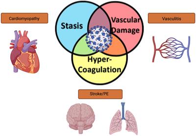 Virchow’s Triad and the Role of Thrombosis in COVID-Related Stroke